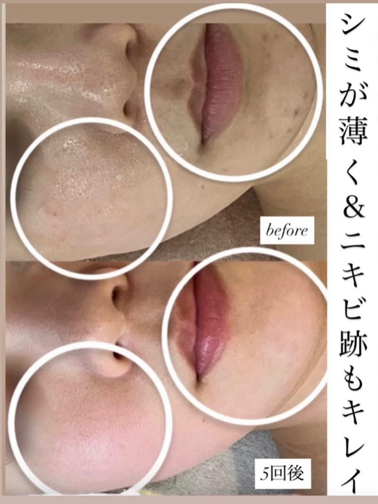 ✨シミケアで来店 → 今は全身脱毛5回目です✨