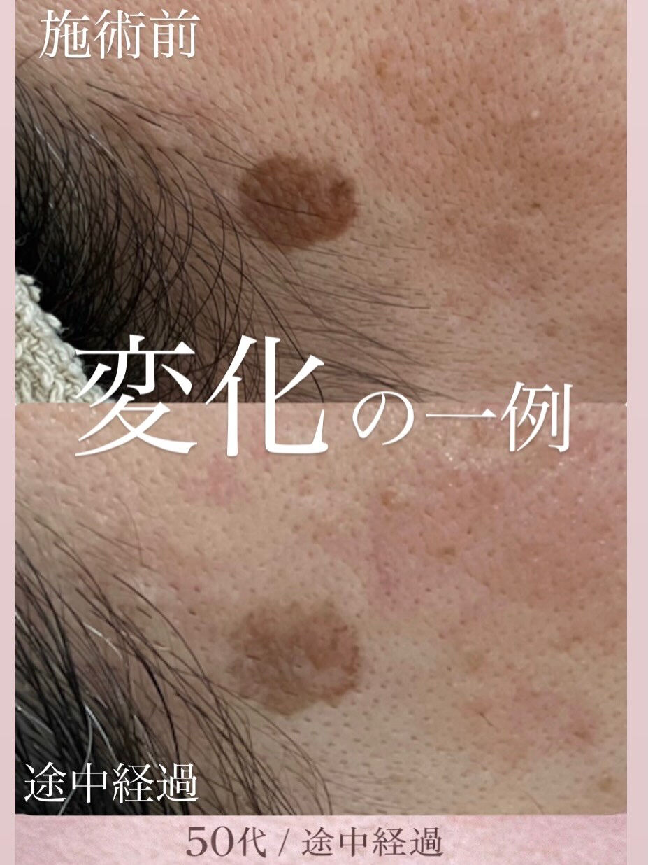 【5回でここまで変化✨フォト＋シミケア】