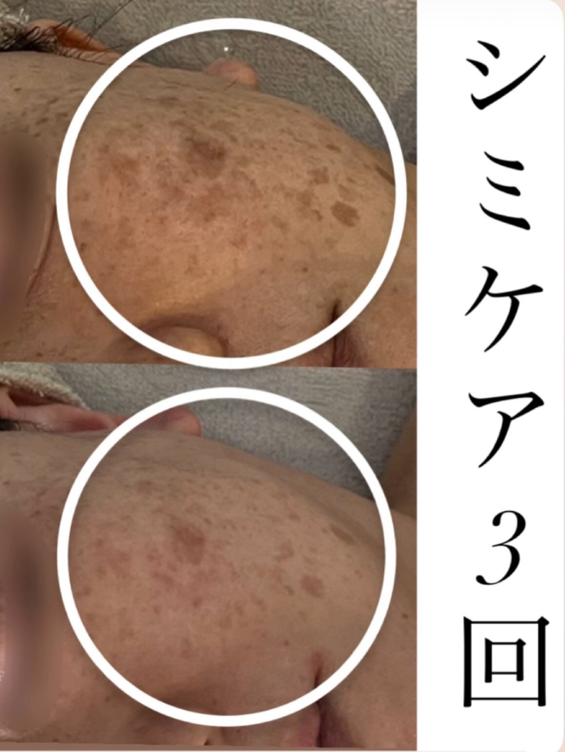 【5回でここまで変化✨フォト＋シミケア】